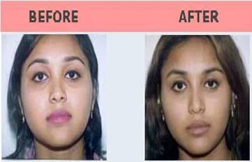 Rhinoplasty Before & After Photo - Dr. Manoj Khanna