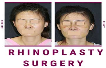 Rhinoplasty Before & After Photo - Dr. Milan Doshi