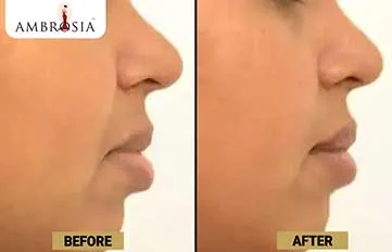 Rhinoplasty Before & After Photo - Dr. Priti Shukla