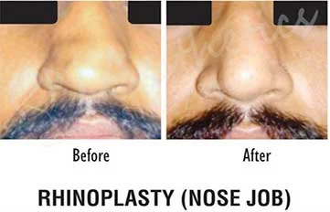 Rhinoplasty Before & After Photo - Dr. Ravi Mahajan