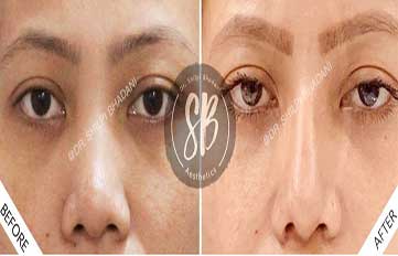 Rhinoplasty Before & After Photo - Dr. Shilpi Bhadani