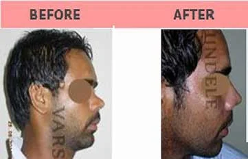 Rhinoplasty Before & After Photo - Dr. Varsha Bundele