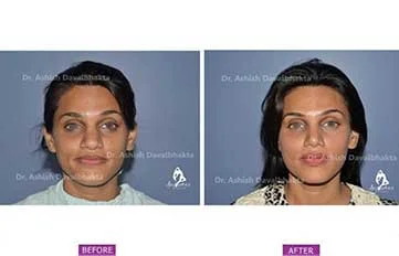 Rhinoplasty Before & After Photo - Dr. Ashish Davalbhakta