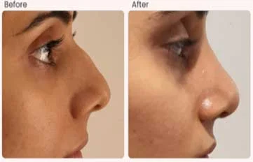 Rhinoplasty Before & After Photo - Dr. Rajat Gupta