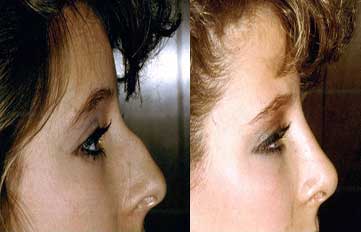 Rhinoplasty Before & After Photo - Dr. Bhangoo